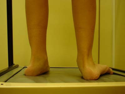 A la psoriasis se hinchan fuerte los pies